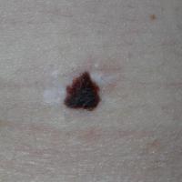 Melanoma in the bin&nbsp;This patient had a…
