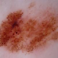 Melanoma clue - irregular dots and globules…