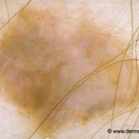 Melanoma clue - eccentric structureless area