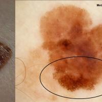 Melanoma clue - pseudopods
Copied with kind…