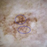 Melanoma clue - polygons ie large angulated…