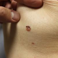 Melanoma - developing from a pre-existing benign…