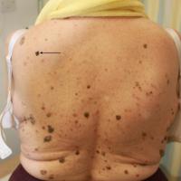 Melanoma, the ugly ducklingBeware of the lesion…