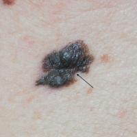 Nodular melanomaA dense, black, irregular lesion…