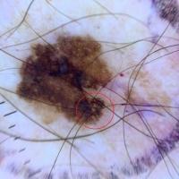 Melanoma with chaotic structuresDifferent types…