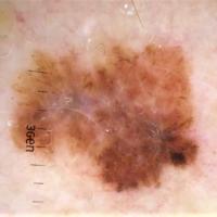 Melanoma with chaotic structures and coloursThe…