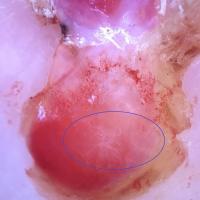 Dermoscopy of previous figure - the clue was…