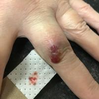 A pink melanoma - on this occasion dermoscopy…