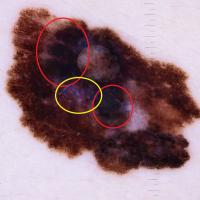 Melanoma clues - skin of colourEccentric…