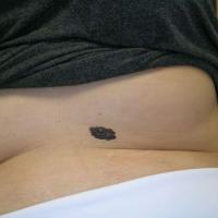 Melanoma - skin of colourCopied with kind…