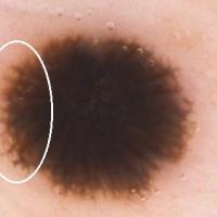 Melanoma clue - streaks (peripheral lines)