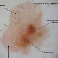 Melanoma clue - atypical dotted vesselsMany pink…