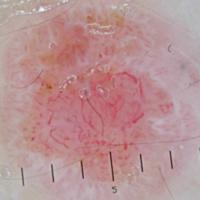 Melanoma clue - atypical vessels
In this case…