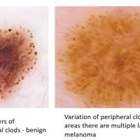 Melanoma clue - irregular dots and globules,…