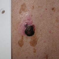 Nodular melanoma - an EFGA black nodule with a…
