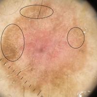 Dermocopic appearance of previous figureNegative…
