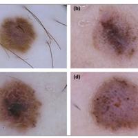 Melanoma clue - negative network