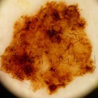 Melanoma clue - atypical network / lines