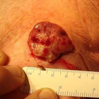 Nodular melanomaAn EFG - all of elevated, firm…