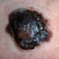 Nodular melanoma
An EFG - all of elevated, firm…