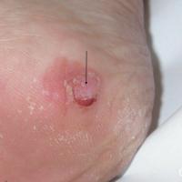 Nodular melanomaSubtle, but still an EFGCopied…