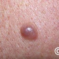 Nodular melanomaAnother subtle lesion, but still…