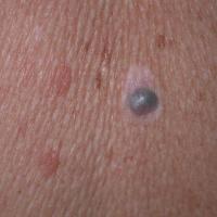Nodular melanomaAn EFG - all of elevated, firm…