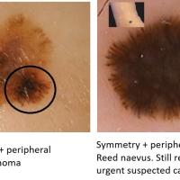 Melanoma clue - asymmetrical streaks (on the left)