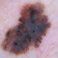 Melanoma clue - pseudopodsCopied with kind…