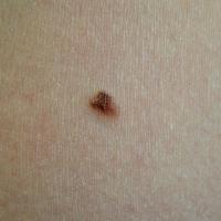Superficial spreading melanomaA = asymmetry of…