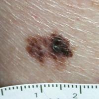
	Superficial spreading melanoma

	Asymmetry…