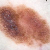 Melanoma clue - shiny white linesSome of these…