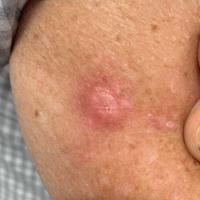 Spindle cell amelanotic melanomaAs with the…