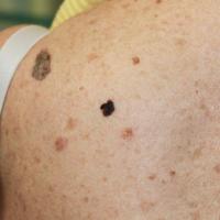 Close-up of previous figure&nbsp;A = asymmetry of…