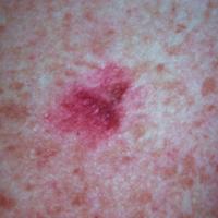 Hypomelanotic melanoma (ie minimal pigment)The…