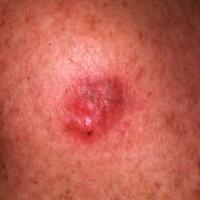 
	Amelanotic melanoma (ie no pigment)
	
	This…