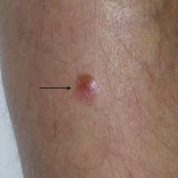Nodular melanoma - an EFGA red and brown…