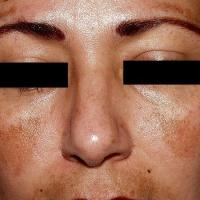 
	Melasma

	Copied with kind permission from…