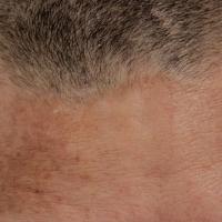 
	Melasma - male&nbsp;