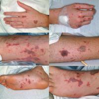
	Meningococcal septicaemia