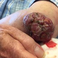 
	Merkel cell carcinoma

	Copied with kind…
