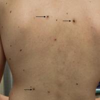Meyerson's naevi - same patient as previous…