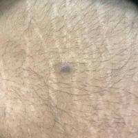 Same patient as previous image, post-topical…