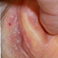 
	Milia post-auricular 