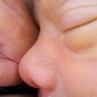Milia in the newborn