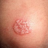 
	Plaque milia in a traumatic scar