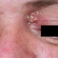 
	Milia resulting from a chemical burn