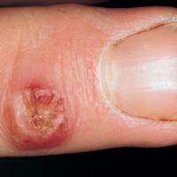 
	Milker's nodule