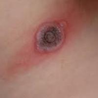 
	Milker's nodule