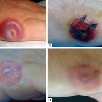 
	Milker's nodule

	Evolution of lesion on…